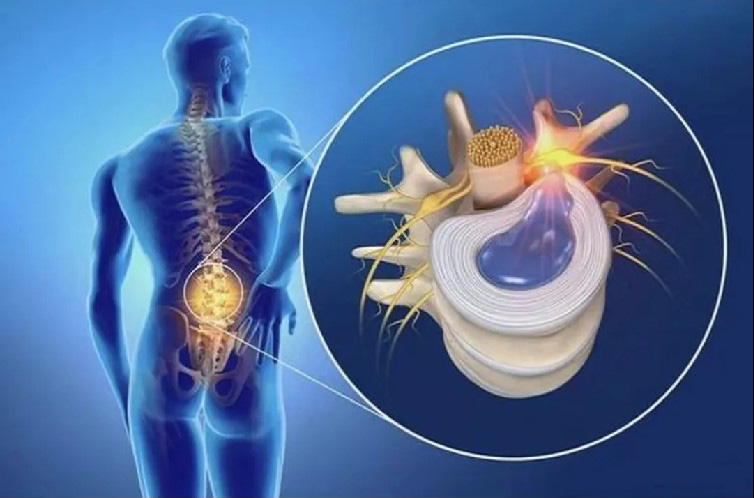 Spinal minimally invasive foraminoscopy technology, small incision to solve big problems!